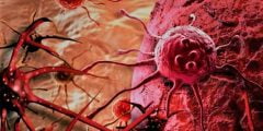 بحث عن مرض السرطان شامل العناصر والمقدمة والخاتمة