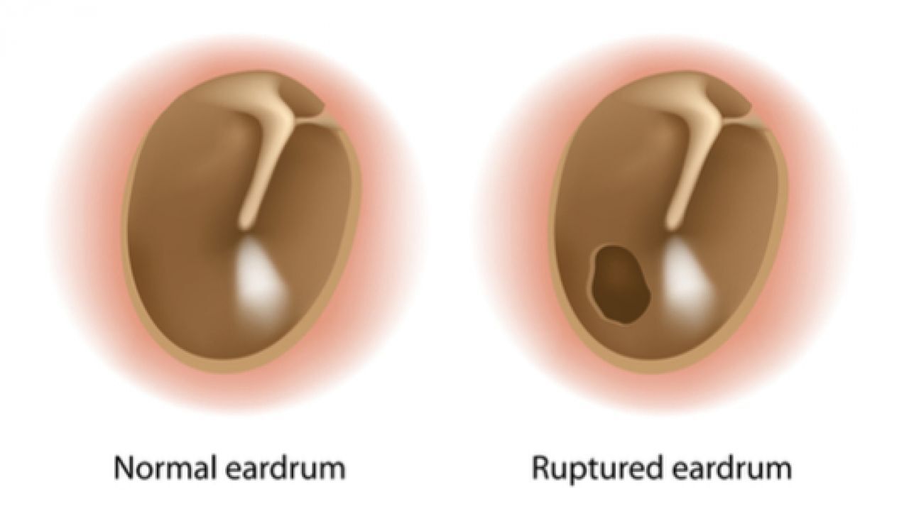 تجربتي مع ثقب طبلة الأذن، كيفية علاج ثقب طبلة الأذن