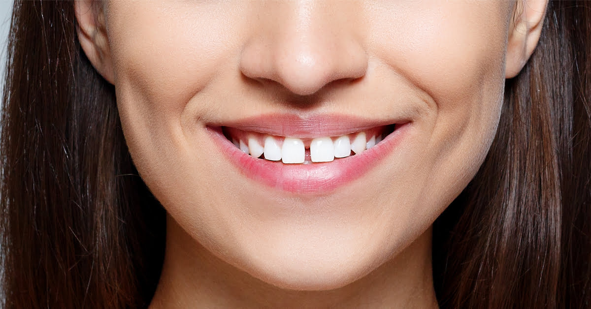كيفية علاج الاسنان المتفرقه نهائيا بطريقة سريعة