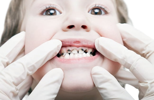 كيفية علاج الاسنان للاطفال بطرق طبيعية مجربة