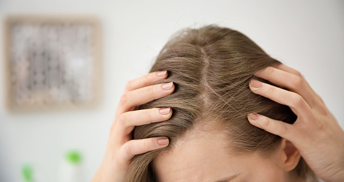 وصفات علاج قشرة الشعر بطرق طبيعية والاستغناء