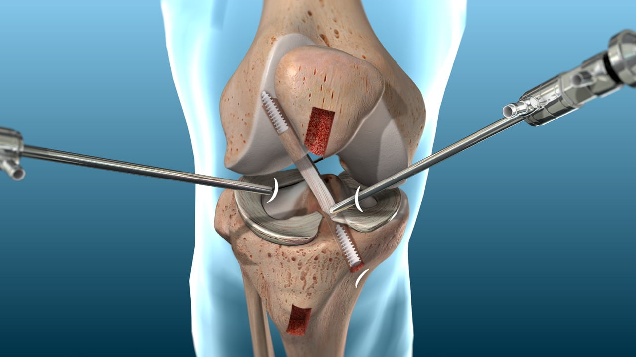 كم مدة علاج قطع غضروف الركبة بدون جراحة