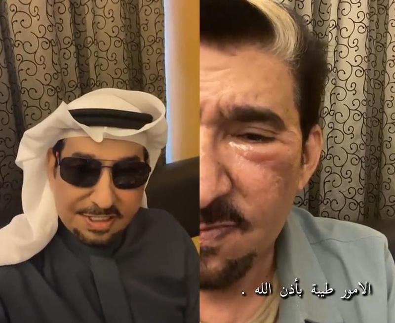 الممثل عبدالله السدحان يتعرض لإصابة بالغة في الوجه أثناء التصوير