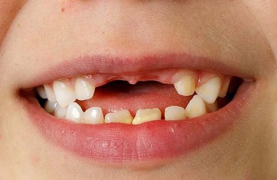 تفسير حلم وقوع الاسنان في المنام