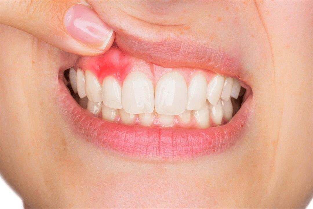 علاج التهاب اللثة وطرق الحفاظ على الفم والأسنان