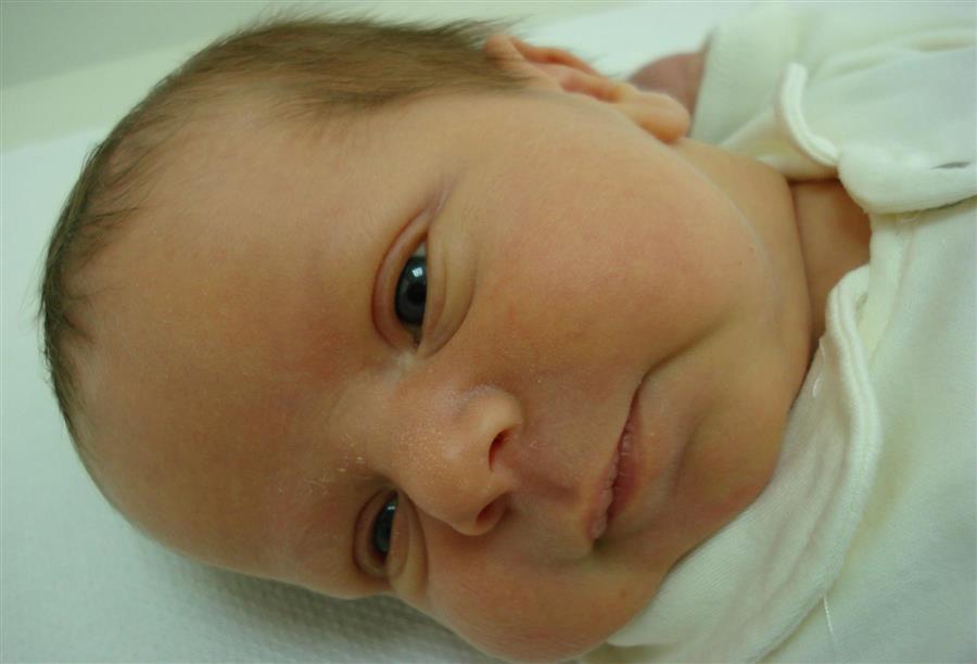 معرفة نسبة الصفار عند الأطفال حديثي الولادة واهم الاعراض